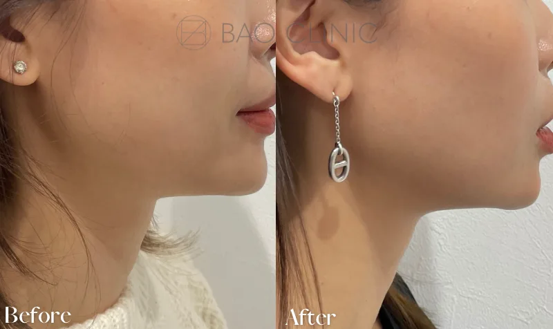 ボトックスリフトの症例写真（施術前・施術後）