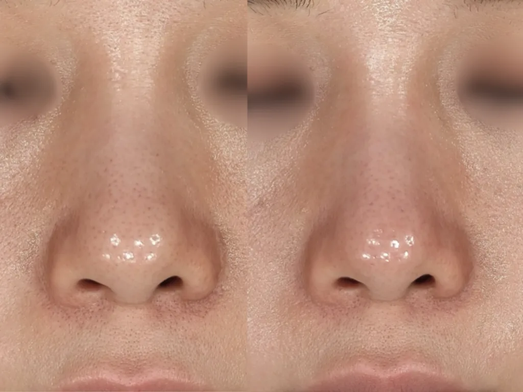キュアジェット　2回の症例写真（施術前・施術後）
