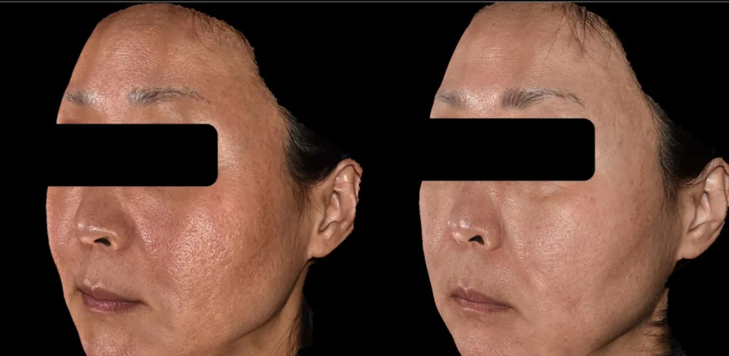ジュベルック3cc ドクター手打ち 2回施術の症例写真（施術前・施術後）