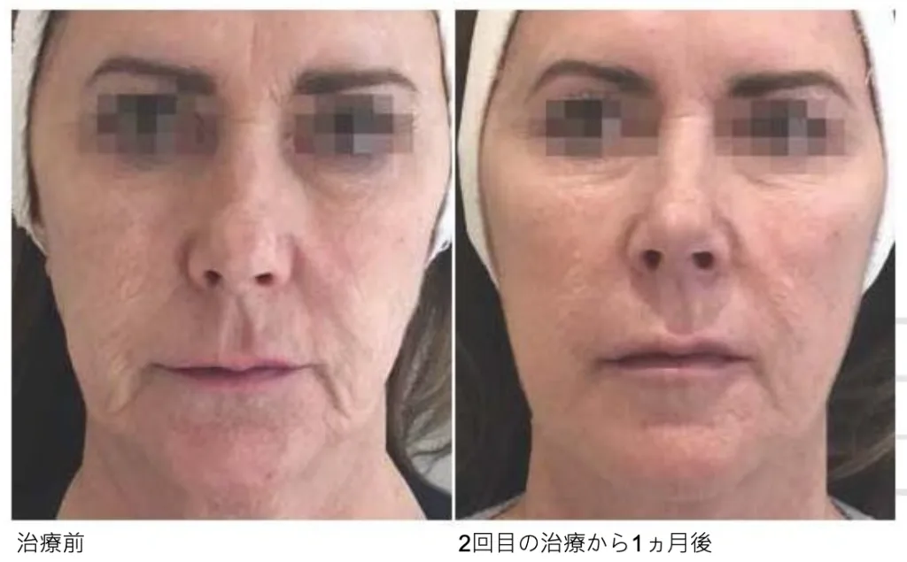 プロファイロ（4週間間隔で2回注射）の症例写真（施術前・施術後）