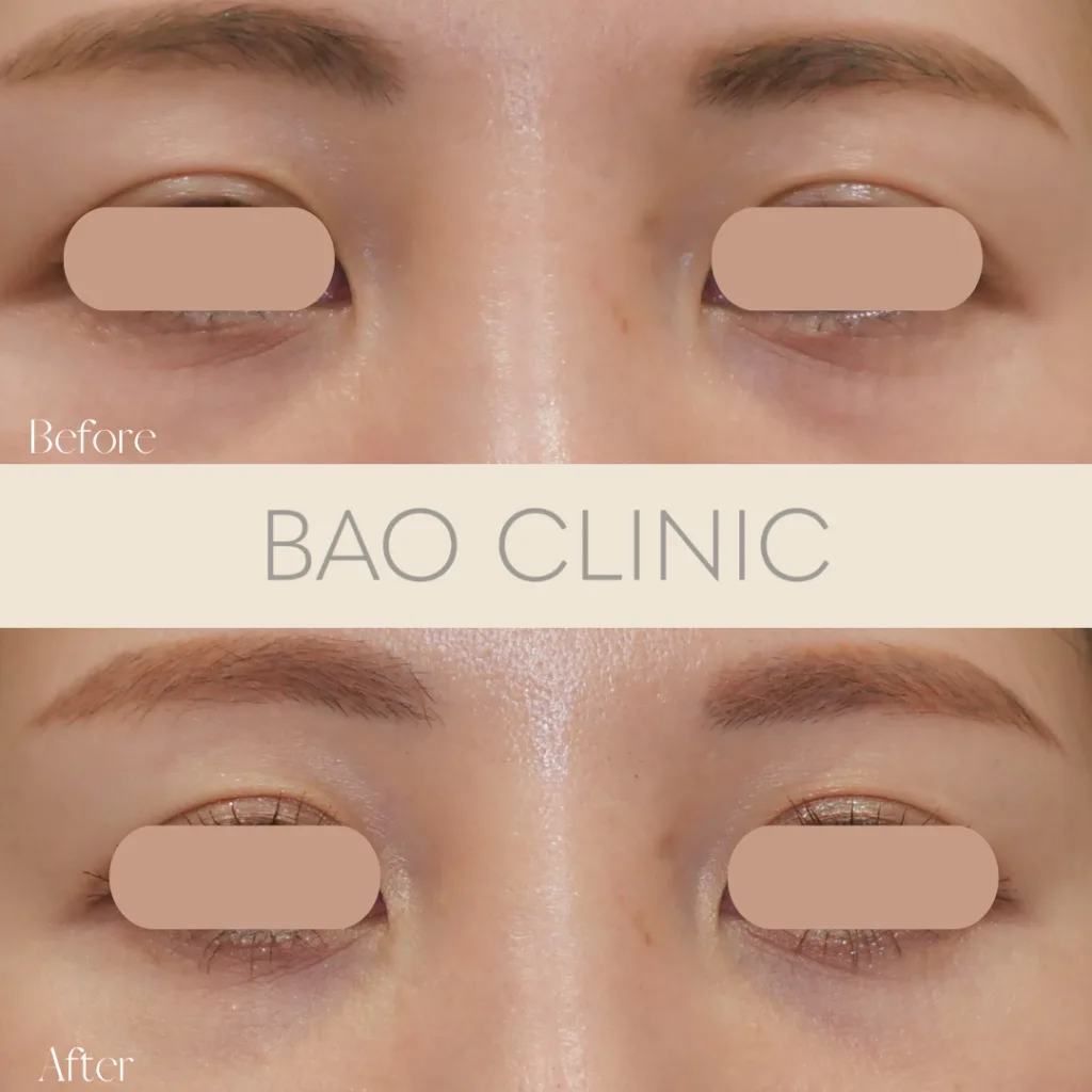 リジュランi 1ccを1回注入の症例写真（施術前・施術後）